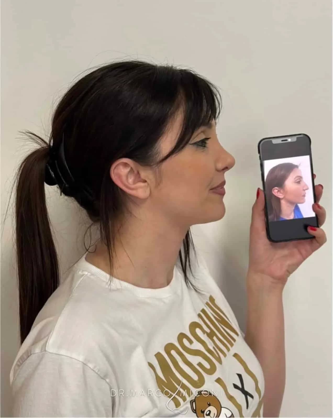 Dopo la rinoplastica